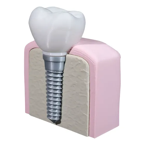 Modelo Anatômico Implante Dentário